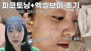 난생 처음 기미잡티 제거하러 피부과 피코토닝+엑셀V 비타민관리까지 내돈내산 후기