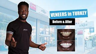 Veneers in Turkey 2021 - Before/After | Myra Dental Centre Turkey