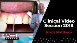 Immediate implants with guided surgery w/ Nikos Mattheos | Clinical Video Session 2018