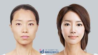 [id hospital review korean plastic surgery] amazing makeover show, Let Me In hospital