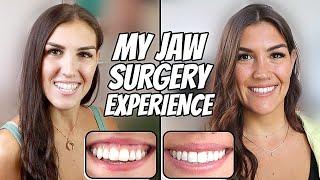 My Double Jaw Surgery Experience 2022 (Before and After 5 Months Post Op)