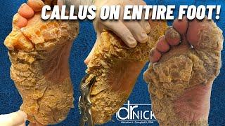 SHAVING CALLUS ON ENTIRE SOLE OF FOOT!!! Dr. Nick Campitelli, Foot & Ankle Surgeon