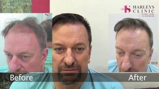 Harleys Hair Transplant Clinic in Mumbai Review - Medical tourism