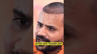 Youtuber Topa Bhai ( Nadeem Bunny ) Hair Transplant Progress #shorts#hairtransplant