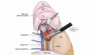 VATS Lobectomy Illustrated by Blackmon for STS