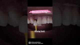 Missing Front Tooth Replaced With Maryland Bridge- by Dr.Praneeth