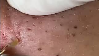 pimple popping - skin care