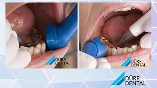 Prophylaxis Cannula - A World First From Durr Dental