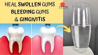 20 secs  KEEP GUMS AND TEETH HAPPY | GINGIVITIS, RECEDING GUMS AND SWOLLEN GUMS TREATMENT