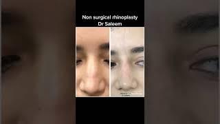 Non surgical rhinoplasty by dr Saleem.#nonsurgicalrhinoplasty #nonsurgicalnosejob