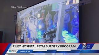 Riley Children's Health fetal surgery program