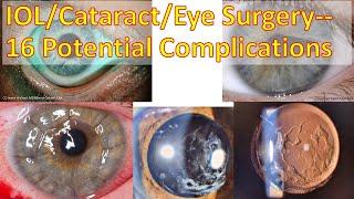 16 Things That Can Go Wrong: Cataract/Eye Surgery (4/4)