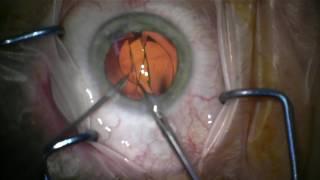 IOL removal and replacement