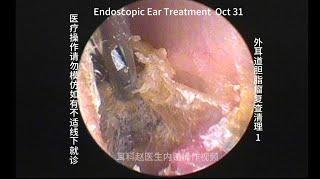 Re examination and cleaning of external auditory canal cholesteatoma 20241031