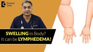 Swollen Limbs Treatment | Lymphedema Causes & Treatment   - Dr. Srikanth V| Doctors' Circle