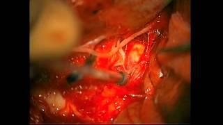 Microsurgical clip reconstruction techniques for aneurysms with significant calcified neck