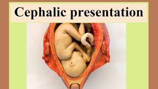 cephalic presentation