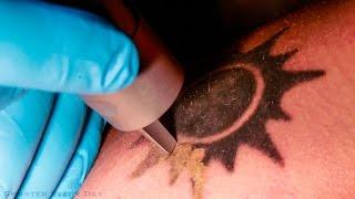 How Laser Tattoo Removal Works - Smarter Every Day 123