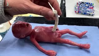 World’s first ever 22-23 weeks micro-preemie