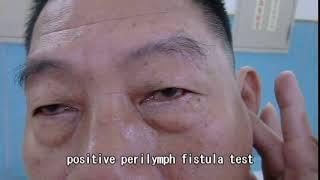 Positive perilymph fistula test