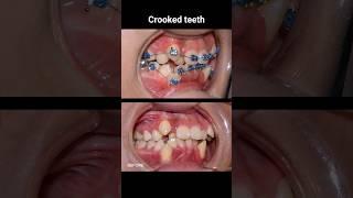 Super crooked Braces in 12 months #braces #orthodontist #dentist