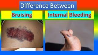 Difference between Bruising  and Internal Bleeding