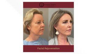 Cosmetic Surgery Associates share everything you need to know about facial rejuvenation