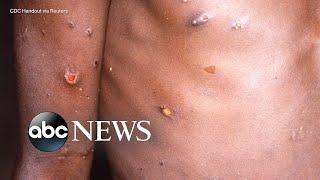 The symptoms, treatment for monkeypox l ABC News