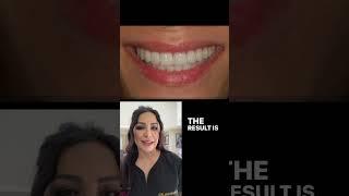 Reverse smile correction  #reversesmile #hollywoodsmile #naturallookingveneers #naturallooking