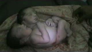 Baby Born With Two Heads In India