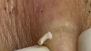 Massive Blackheads removal #27