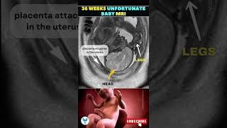 36 Week Baby MRI Reveals Unexpected Challenges #Baby #pregnancy #shortsvideo