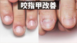 Improvement of nail biting｜Female medical student｜After-effects of nail damage treatment