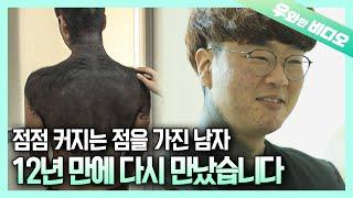 (근황공개) 목부터 다리까지 이어진 점을 가진 남자, 12년 만의 근황┃(Update) The Man With Growing Mole, After 12 Years