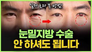 수술 없이 ‘눈밑 지방’ 없애는 법 | "바로 일상생활 할 수 있어요!"