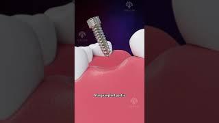 Bone Grafting for Dental Implants #shorts #facts - creativelearning3d