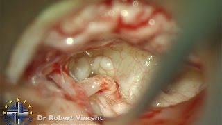 2nd stage tympanoplasty with stapedotomy for oval window tympanosclerosis - Dr Robert Vincent