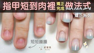 Problem nail correction-bite nails, remove nails, nails are short to the meat, correction is done