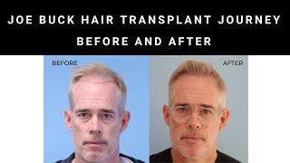 Joe Buck's Incredible Hair Transformation: 8 Months Post FUE Hair Transplant | Before and After