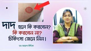 দাদ হলে কি করবেন? কি করবেন না... চিকিৎসা জানুন। Eczema: Ringworm symptoms, causes and treatment