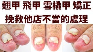 翘甲甲甲甲 雪甲甲 Correction Save his store improper handling - Nail up long nail shape correction