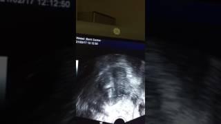 TRANSMYOMETRIAL Embryo Transfer By Dr. Mohamed shehata