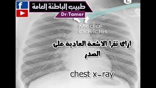 ازاى تقرا الاشعة العادية على الصدر chest X-ray