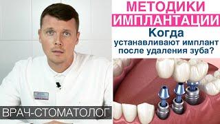 Методики имплантации зубов - немедленная, одномоментная, двухэтапная. Преимущества, противопоказания