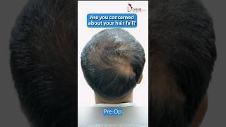 GFC for Hair Loss Treatment | Growth Factor Concentrate Therapy #gfc #shorts