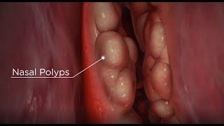 Nasal Polyps: diagnosis and treatment options