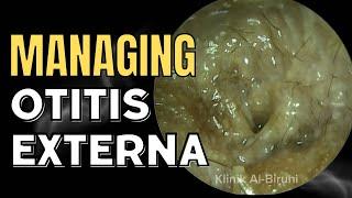 Managing Otitis Externa