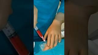 Varicocele embolization live case - Step 1 | Dr. Gaurav Gangwani