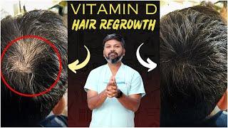 #AskDrJohnWatts | VITAMIN - D  HAIR REGROWTH | Hair Specialist Explains