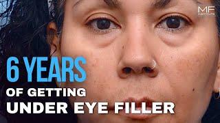 Proof That Fillers Can Get Rid of Dark Under Eye Circles, No Surgery Necessary | MFI in SF, CA